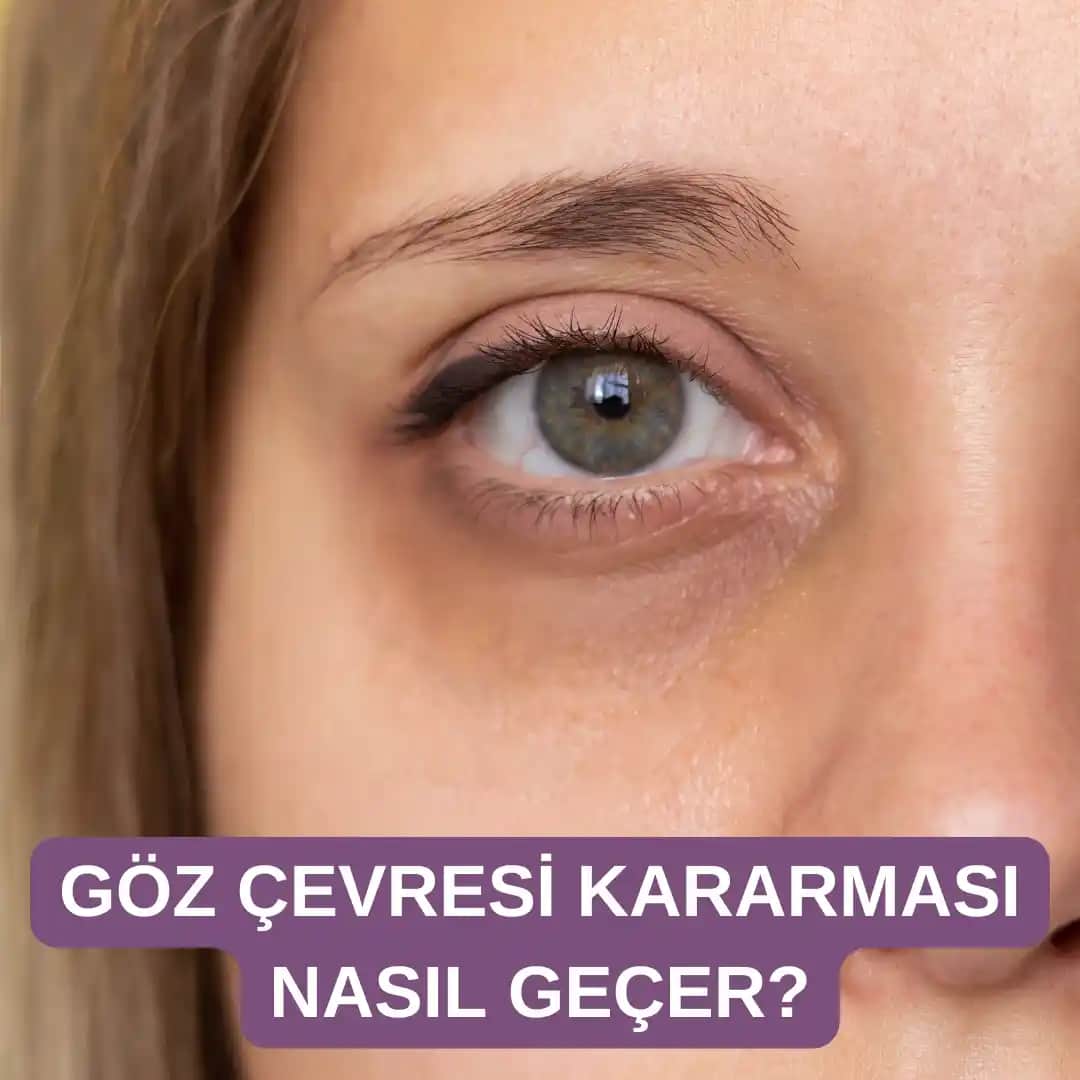 Göz Çevresi Kararmasının Nedenleri ve Göz Sağlığını Koruma Yöntemleri