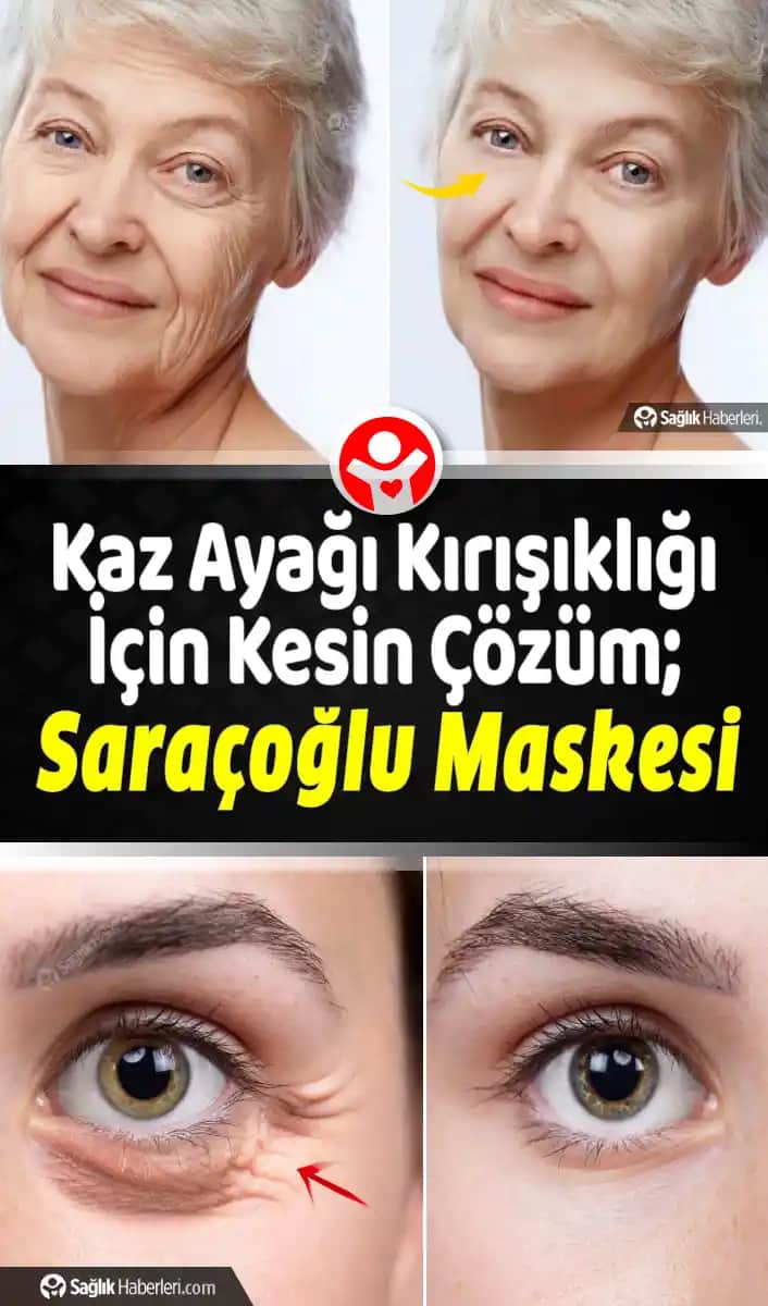 Göz Çevresi Kaz Ayağı Kırışıklıklarını Azaltma Yöntemleri ve Etkili Çözümler
