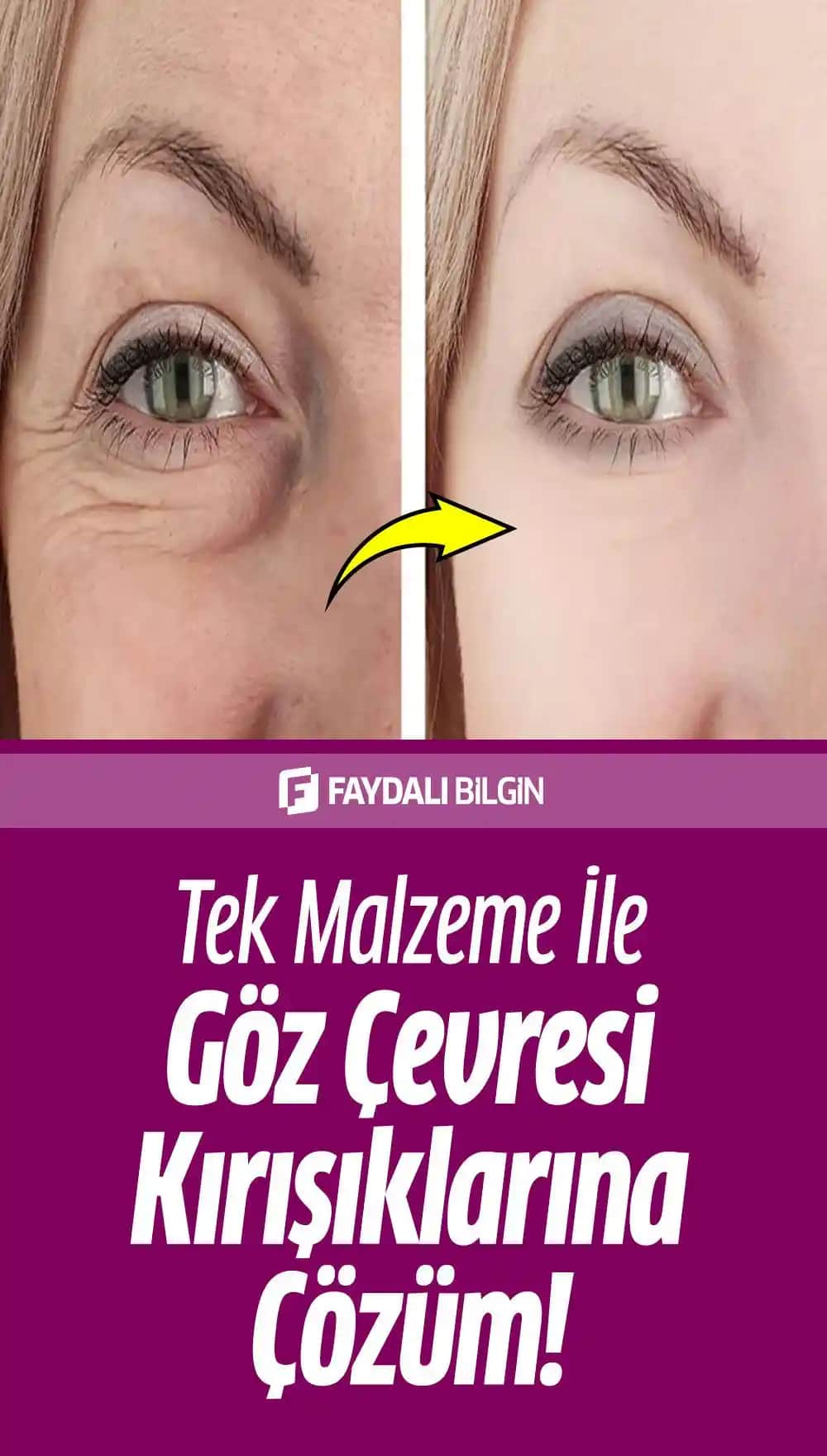 Göz Çevresi Kırışıklıklarını Önleme ve Azaltma Yöntemleri Hakkında Kapsamlı Bilgi