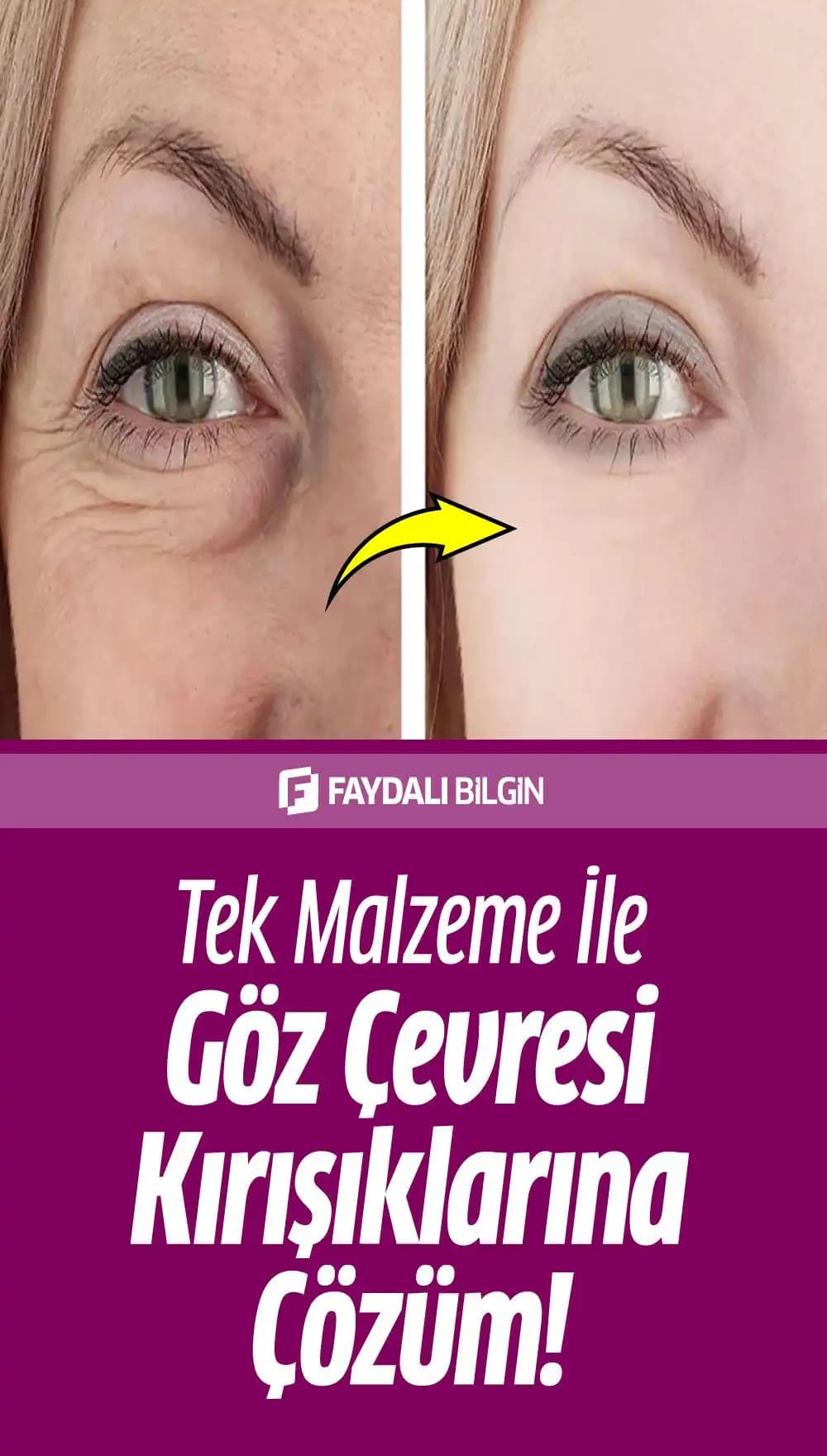 Göz Çevresi Kırışıklıklarını Önleme ve Azaltma Yöntemleri Hakkında Kapsamlı Bilgi