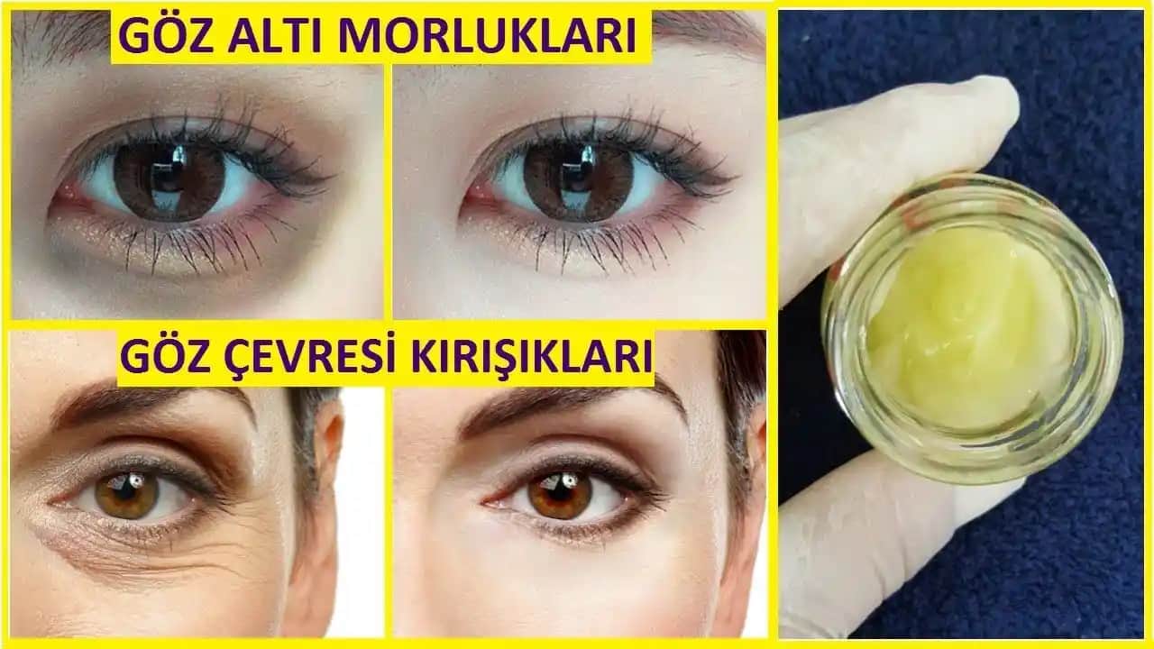 Göz Çevresi Kırışıklıklarının Önlenmesi ve Tedavi Yöntemleri Hakkında Kapsamlı Rehber
