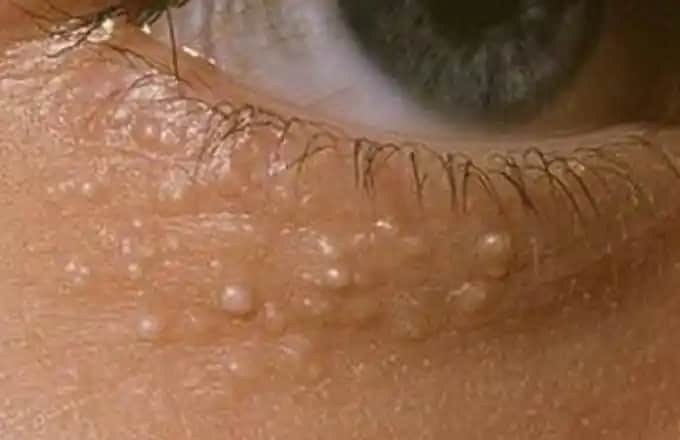 Göz Çevresinde Sivilce Nedenleri, Belirtileri ve Etkili Çözüm Yolları