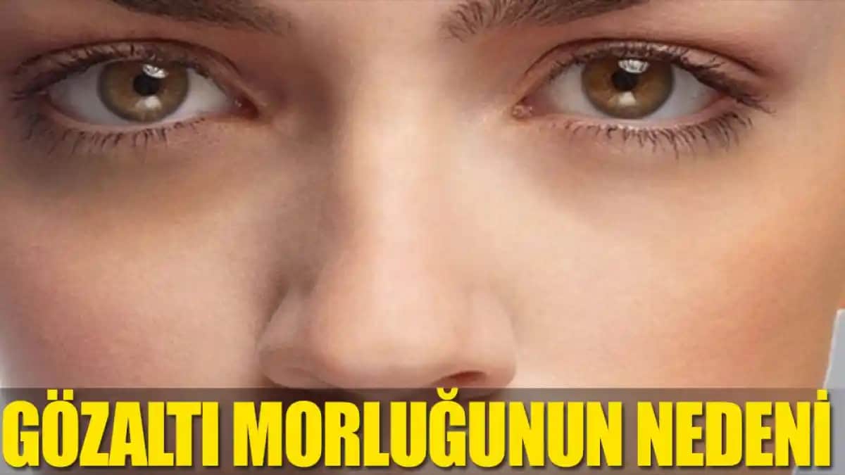 Göz Etrafı Morarmasının Nedenleri ve Alınabilecek Önlemler Hakkında Kapsamlı Bilgi