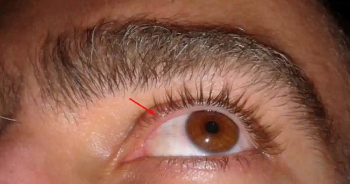 Göz İçinde Çıkan Sivilceler ve Göz Sağlığını Koruma Yöntemleri