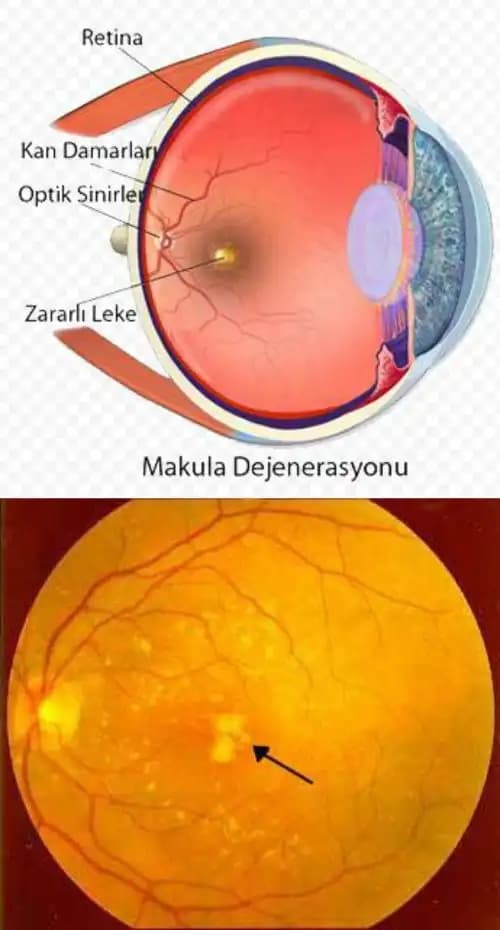 Göz İçinde Sarı Leke Nedenleri ve Sağlık ile Kozmetik Etkileri Hakkında Detaylı Bilgi