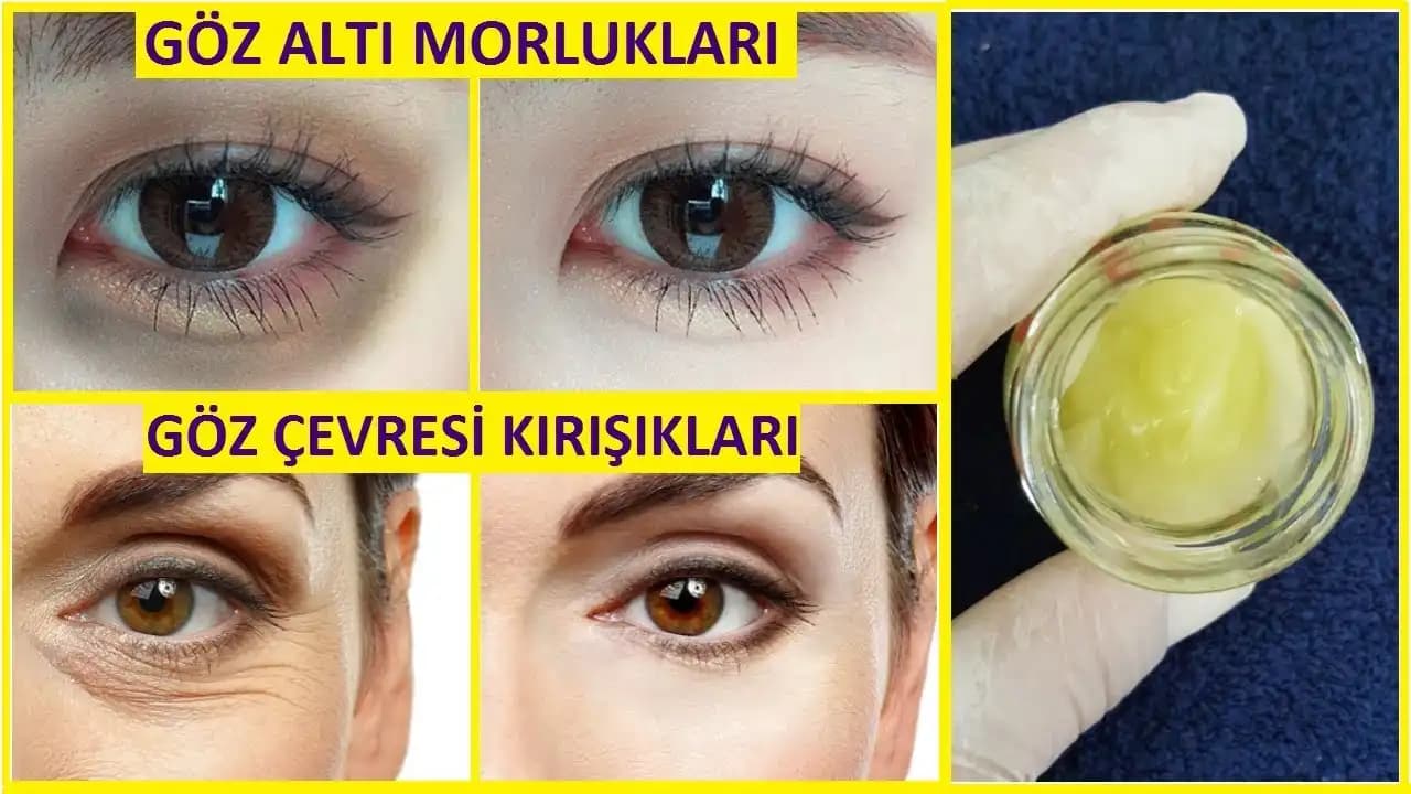 Göz Kapağı Kırışıklıklarına Karşı Etkili Çözümler ve Bakım İpuçları