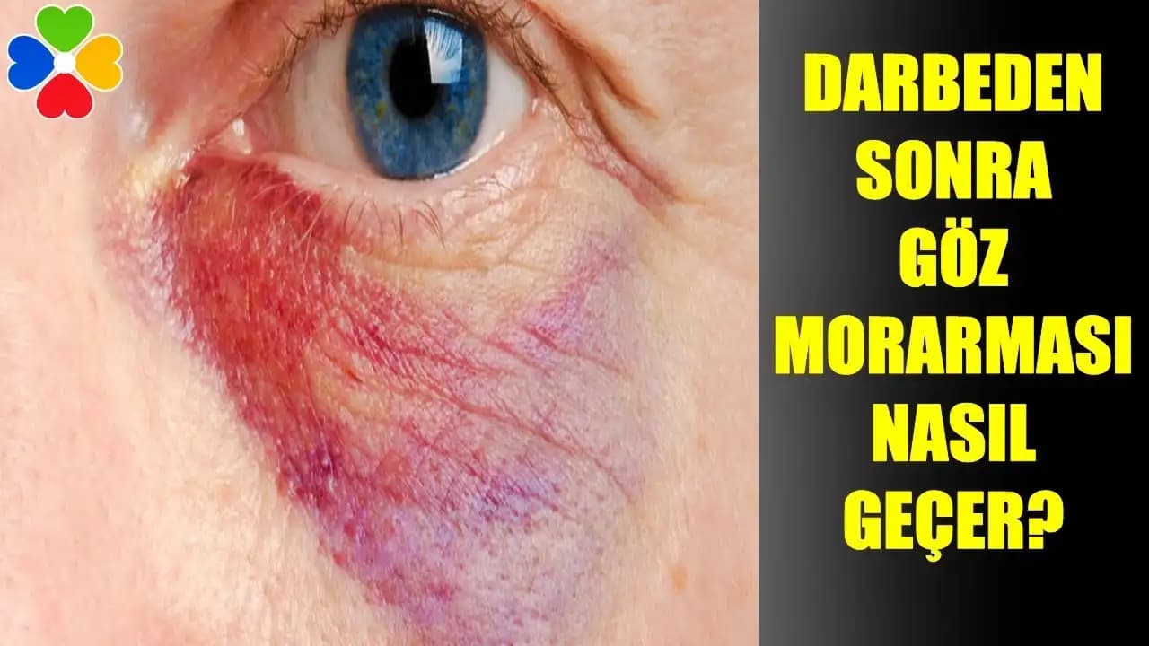 Göz Kapağında Morluk Nedenleri ve Etkili Önleme Yöntemleri