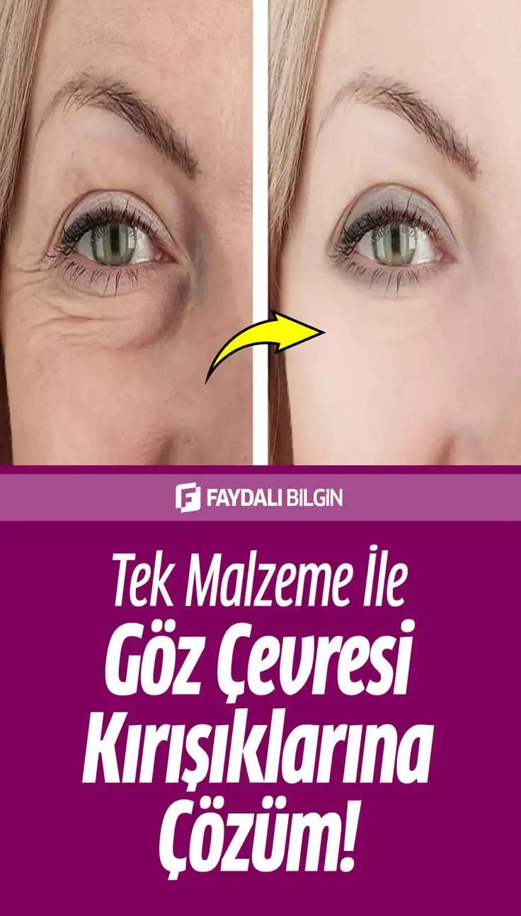 Göz Kenarı Kırışıklıklarını Azaltmak İçin Etkili Yöntemler ve Bakım İpuçları