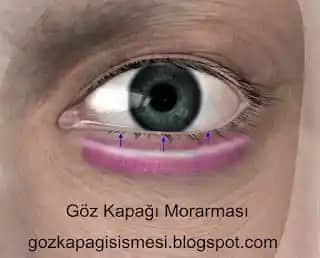 Göz Morarması Nasıl Geçer Göz Çevresi Bakımı ve Kozmetik İpuçlarıyla Parlak Gözler