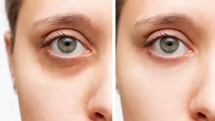 Gözaltı Çökmesi Nedenleri ve Güzellik ile Sağlık Perspektifinden Çözüm Yöntemleri