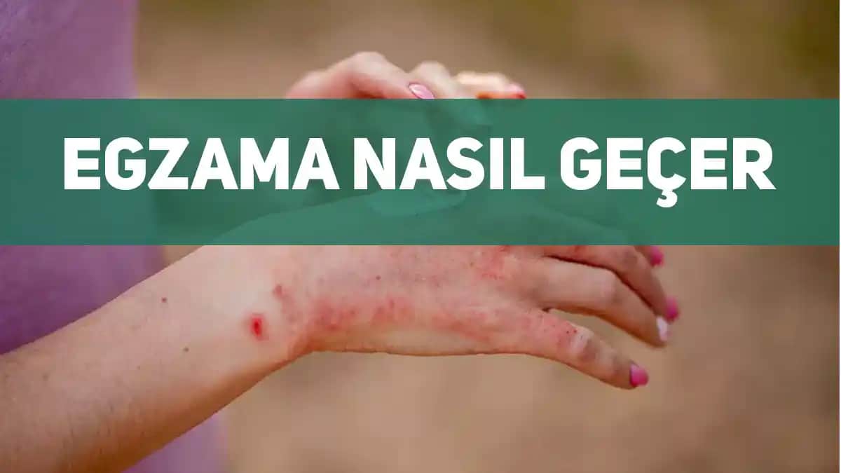 Gözde Egzama Nedenleri, Belirtileri ve Etkili Tedavi Yöntemleri Hakkında Kapsamlı Bilgi