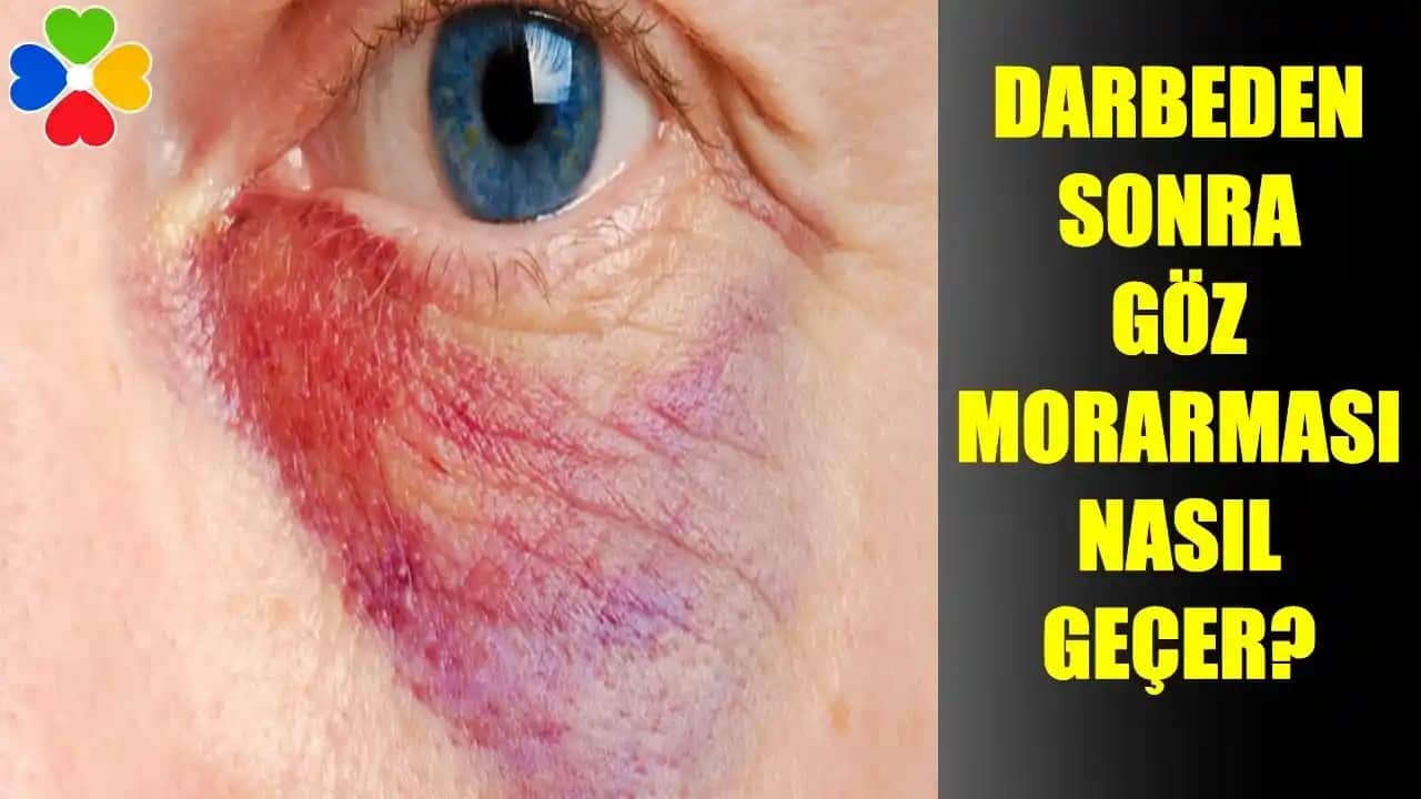 Gözde Morarma Nedenleri, Belirtileri ve Korunma Yolları Hakkında Bilgiler