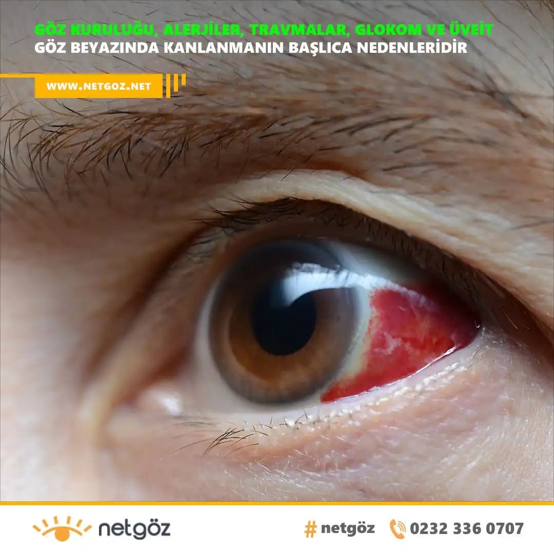 Gözdeki Kılcal Damarlar ve Estetik Çözüm Yöntemleri Hakkında Bilgiler