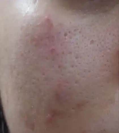 Gözeneklerin Genişlemesi ve Cilt Sağlığını Koruma Yöntemleri Hakkında Detaylı Rehber