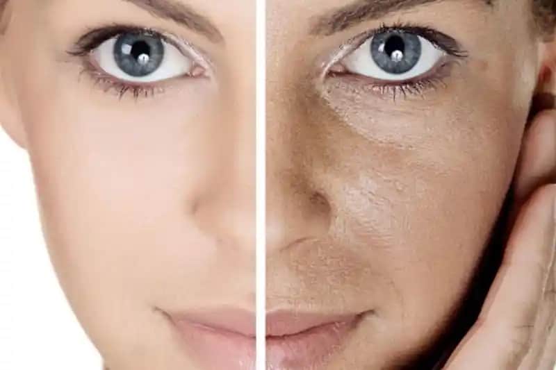 Gözenekli Cilt Tedavisi ve Güncel Yaklaşımlar: Doğru Bakım ve Uygulamalar