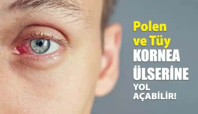 Gözlerde Güneş Alerjisi: Belirtiler, Korunma Yöntemleri ve Kozmetik Çözümler