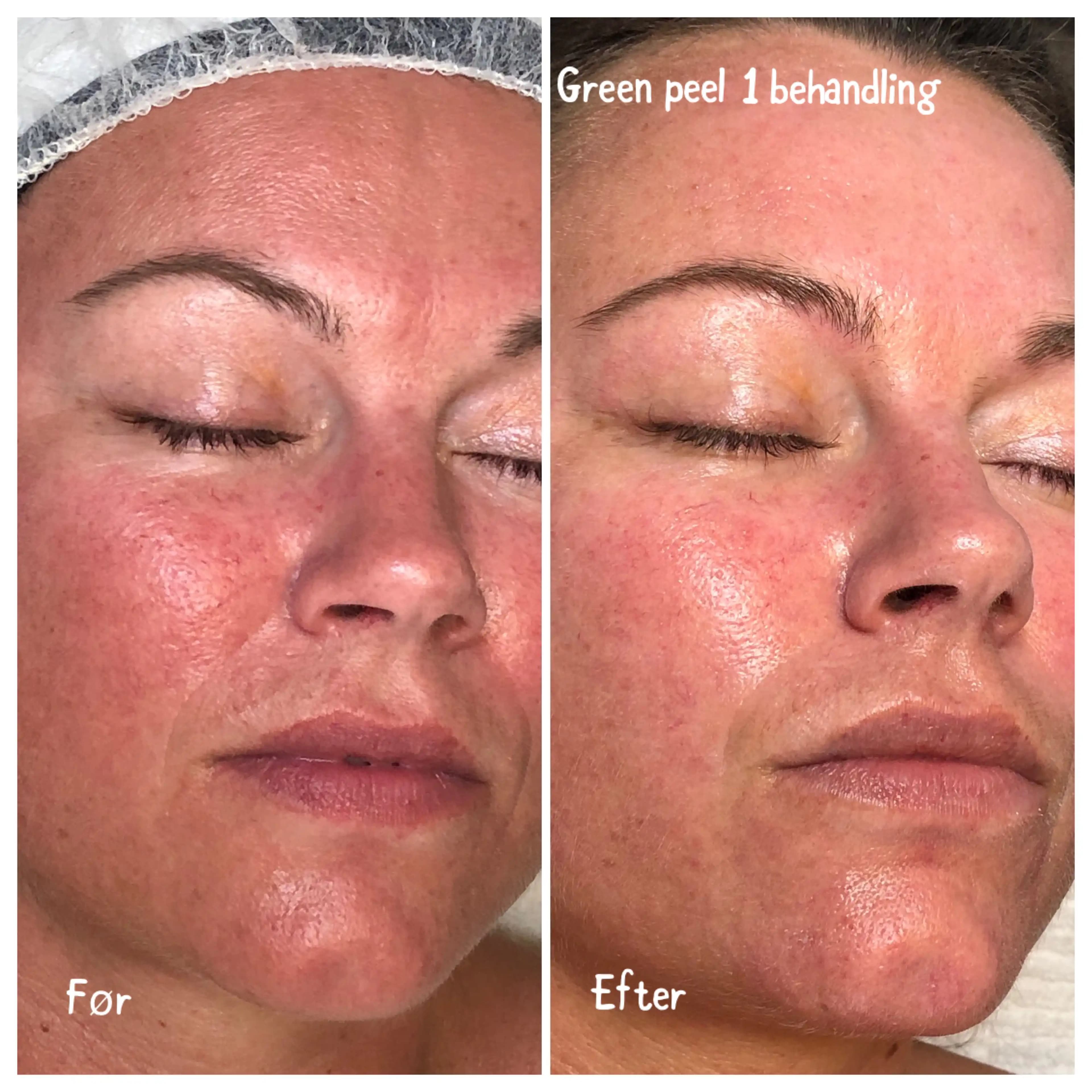 Green Peeling Nedir ve Doğal Cilt Yenileme Yöntemleri Arasındaki Yeri