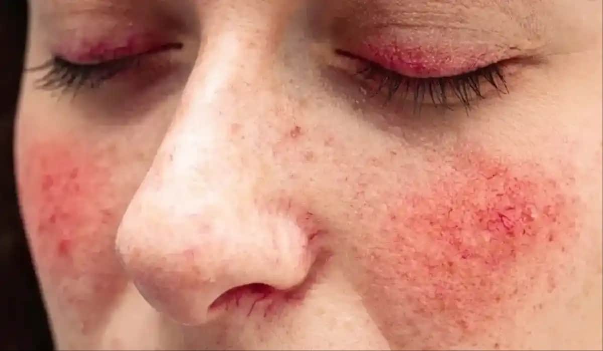 Gül Hastalığı Nedenleri, Belirtileri ve Korunma Yolları Hakkında Kapsamlı Bilgi