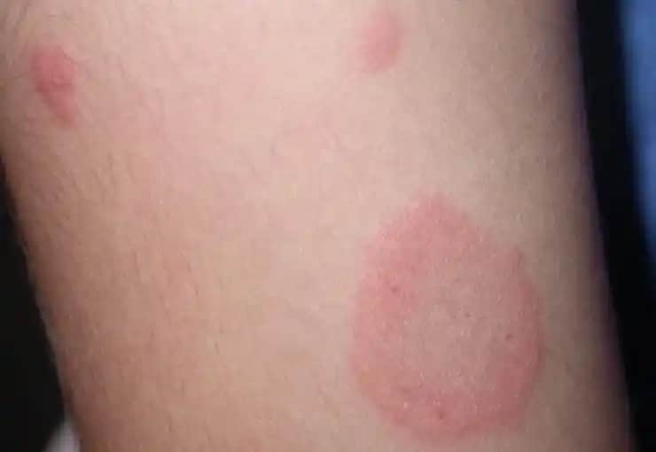 Gül Hastalığı Nedir Bulaşıcı Mı? Cilt Bakımında Bilinmesi Gerekenler