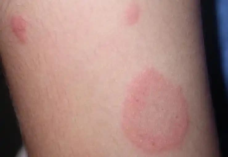 Gül Hastalığı Nedir Bulaşıcı Mı? Cilt Bakımında Bilinmesi Gerekenler