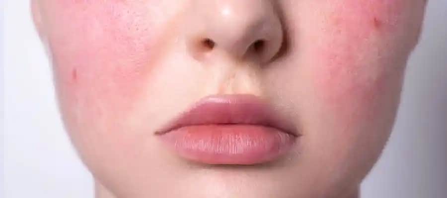 Gül Hastalığı ve Burun Büyümesi: Kozmetik ve Sağlık Açısından Detaylı İnceleme