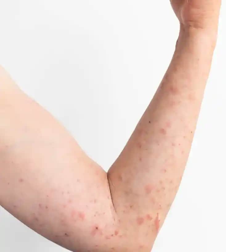 Gül Hastalığı ve Kaşıntı: Cilt Sağlığını Koruma Yöntemleri ve Belirtileri