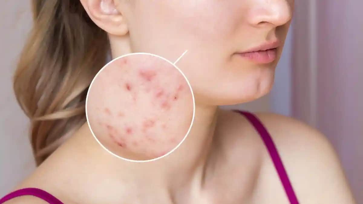 Gül Hastalığı ve Kozmetik Ürünler Arasındaki Denge: Belirtiler, Riskler ve Doğru Bakım