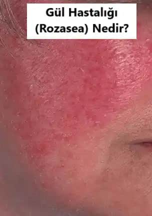 Gül Hastalığı ve Kozmetik Uygulamalarının Tekrarlama Riski Üzerine Bilinmesi Gerekenler