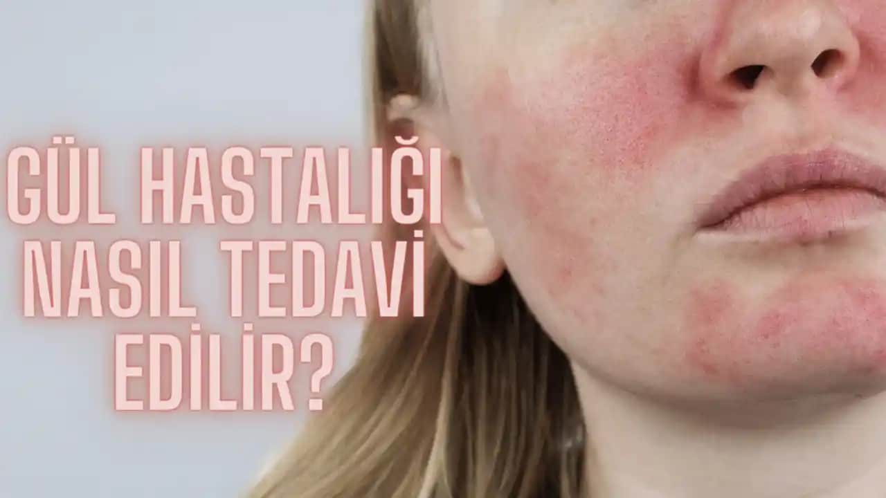 Gül Hastalığında Doğru Beslenme Yöntemleri ve Kaçınılması Gereken Yiyecekler