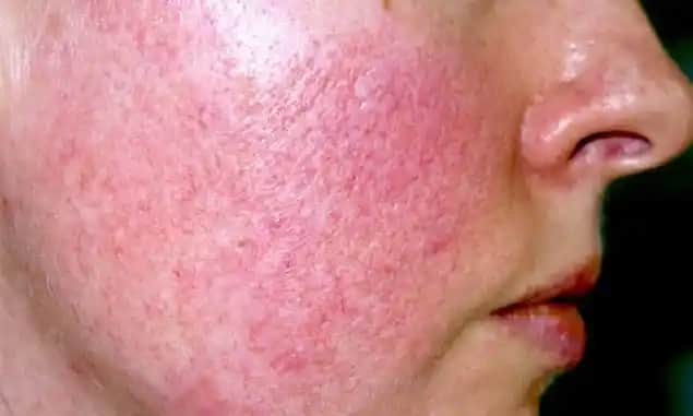 Gül Hastalığının Başlangıcı ve Kozmetik Bakım İpuçları Rehberi