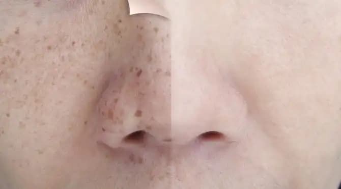 Güneş Kaynaklı Yüzde Oluşan Kırmızı Lekelerin Nedenleri ve Etkili Çözüm Yolları