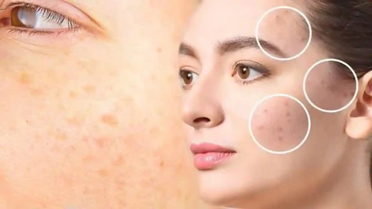 Güneş Lekeleri Nasıl Geçer ve Cilt Sağlığını Koruma Yöntemleri