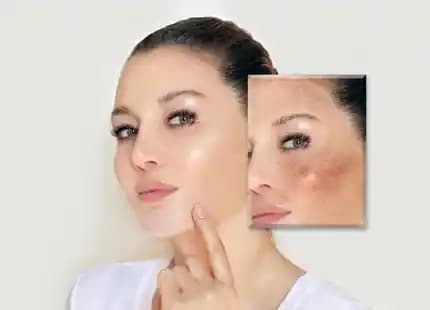 Güneş Lekeleri Nasıl Giderilir: Etkili Yöntemler ve Koruyucu Tavsiyeler