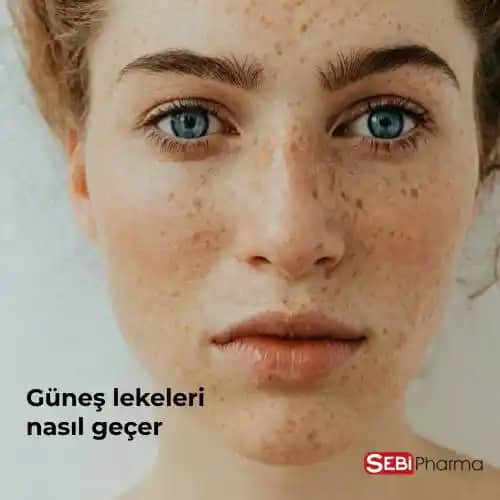 Güneş Yanığı Lekeleri Nasıl Geçer ve Cilt Sağlığını Koruma Yöntemleri