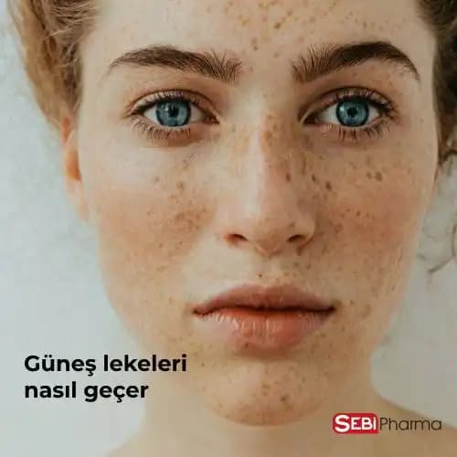 Güneş Yanığı Lekeleri Nasıl Geçer ve Cilt Sağlığını Koruma Yöntemleri