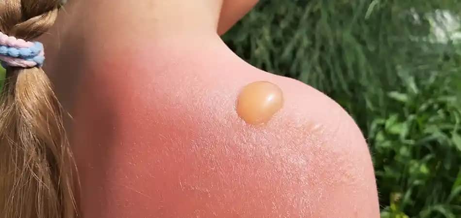 Güneş Yanığının Bilinmeyen Faydaları ve Güvenli Güneşlenme Yöntemleri