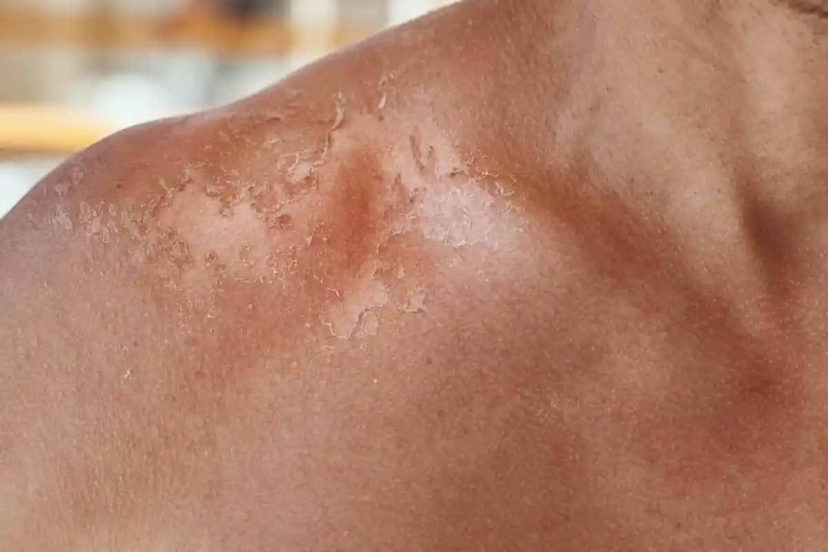 Güneşte Yanmış Cilde Doğal ve Etkili Bakım Yöntemleri ve Koruyucu Tavsiyeler