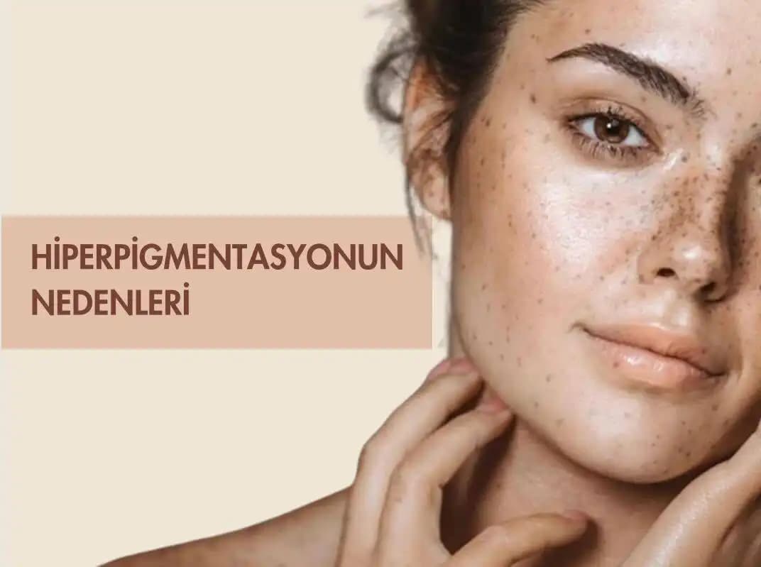 Hiperpigmentasyon Nedir ve Ciltteki Renk Değişiklikleri İçin Etkili Çözüm Yolları