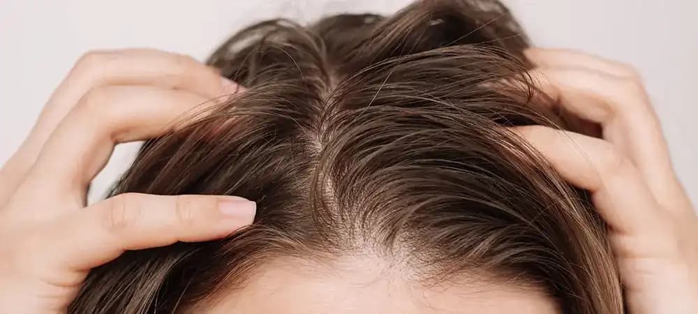 Hormonal Dengesizliklerin Saç Yağlanmasına Etkisi ve Etkili Çözüm Yolları
