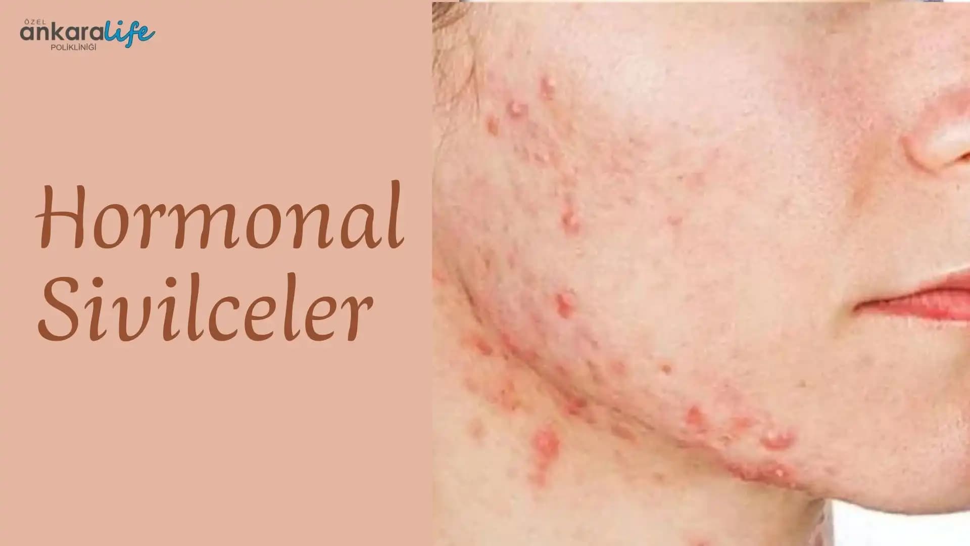 Hormonal Sivilceler ile Mücadele: Belirtileri, Nedenleri ve Etkili Çözüm Yöntemleri