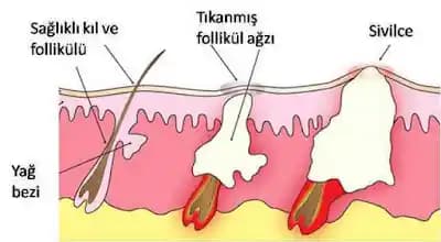 İçi Boş Sivilce Nedir, Nedenleri, Belirtileri ve Etkili Çözüm Yolları