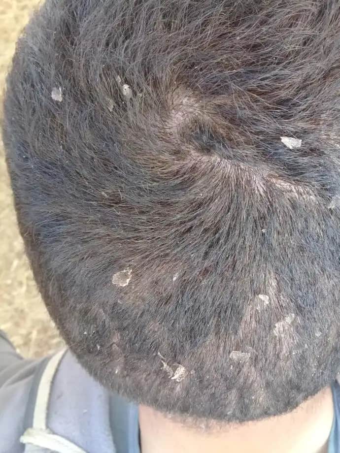 Kafada Deri Soyulmasının Nedenleri ve Etkili Koruma Yöntemleri