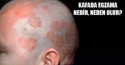 Kafada Egzema Sorunu ve Doğal Bakım Yöntemleri Hakkında Bilgilendirici Rehber