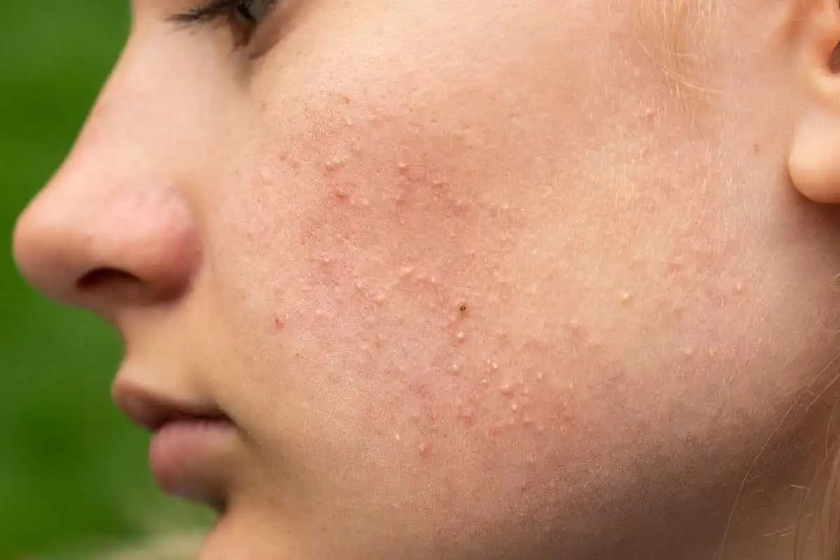 Kafada Küçük Sivilceler: Nedenleri, Belirtileri ve Etkili Çözüm Yolları
