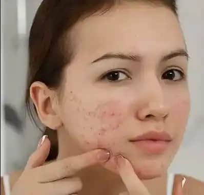 Kafein ve Sivilce İlişkisi: Bilimsel Bulgular ve Cilt Sağlığı Üzerindeki Etkileri