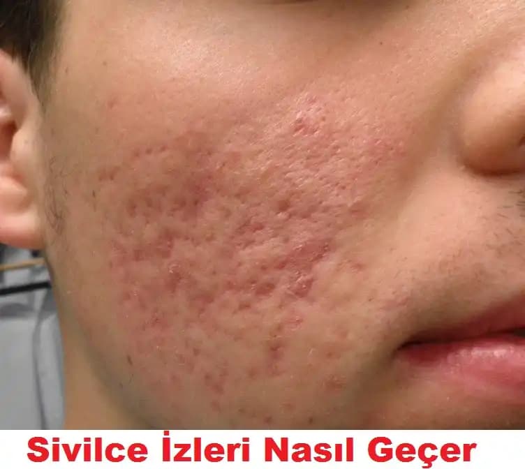 Kahverengi Sivilce İzleri Nasıl Geçer: Etkili Yöntemler ve Cilt Bakımı Tavsiyeleri