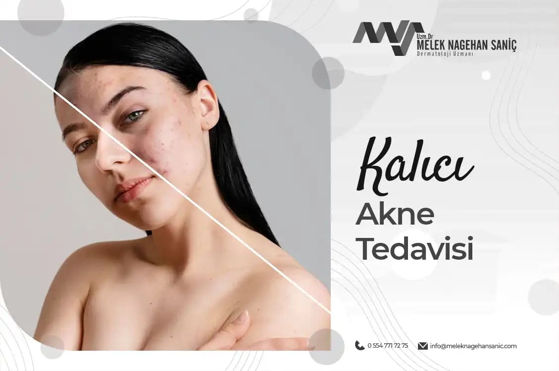 Kalıcı Akne Tedavisi ve Estetik Yaklaşımlar: Etkili ve Güvenilir Çözüm Yöntemleri