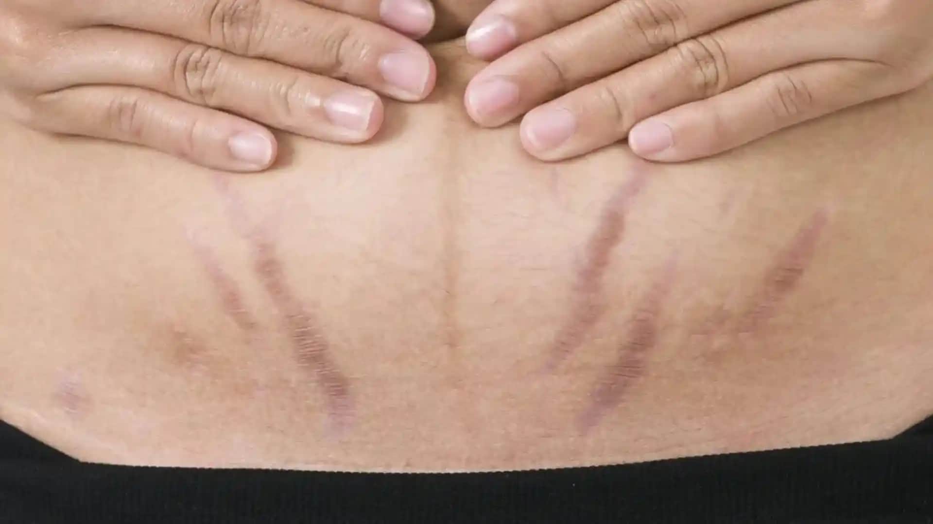 Karın Bölgesinde Kızarıklık Nedenleri ve Etkili Çözüm Yöntemleri