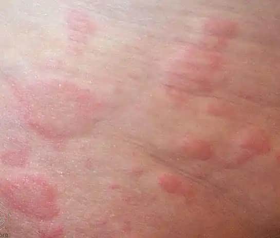 Karında Kızarıklık ve Kaşıntı: Kozmetik Ürünlerle İlişkili Sorunlar ve Çözüm Yolları