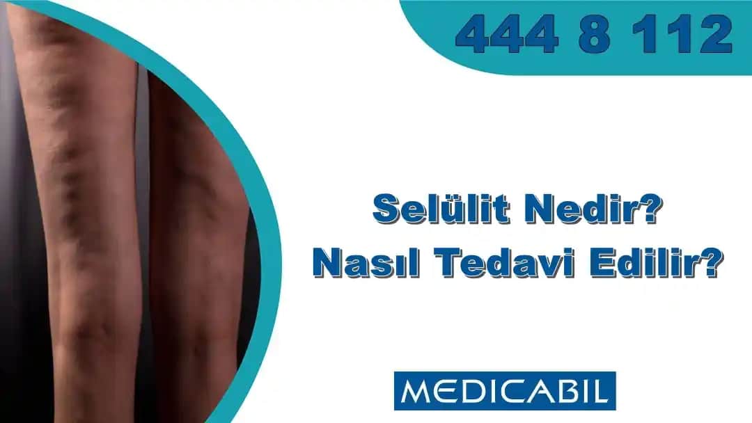 Karında Selülit: Kozmetik Yaklaşımlar ve Etkili Çözümler Hakkında Bilmeniz Gerekenler